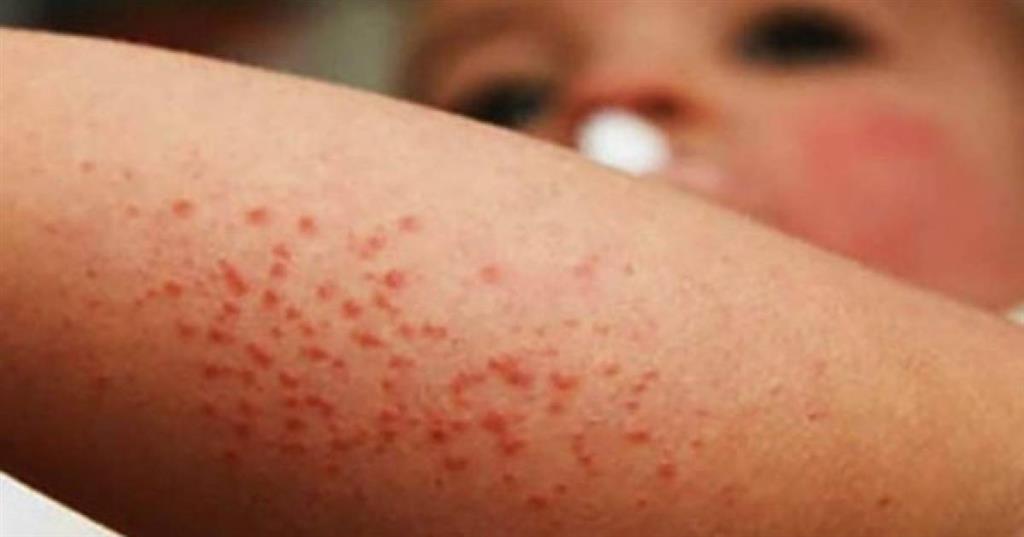 Honduras declara alerta por casos de sarampión en Estados Unidos